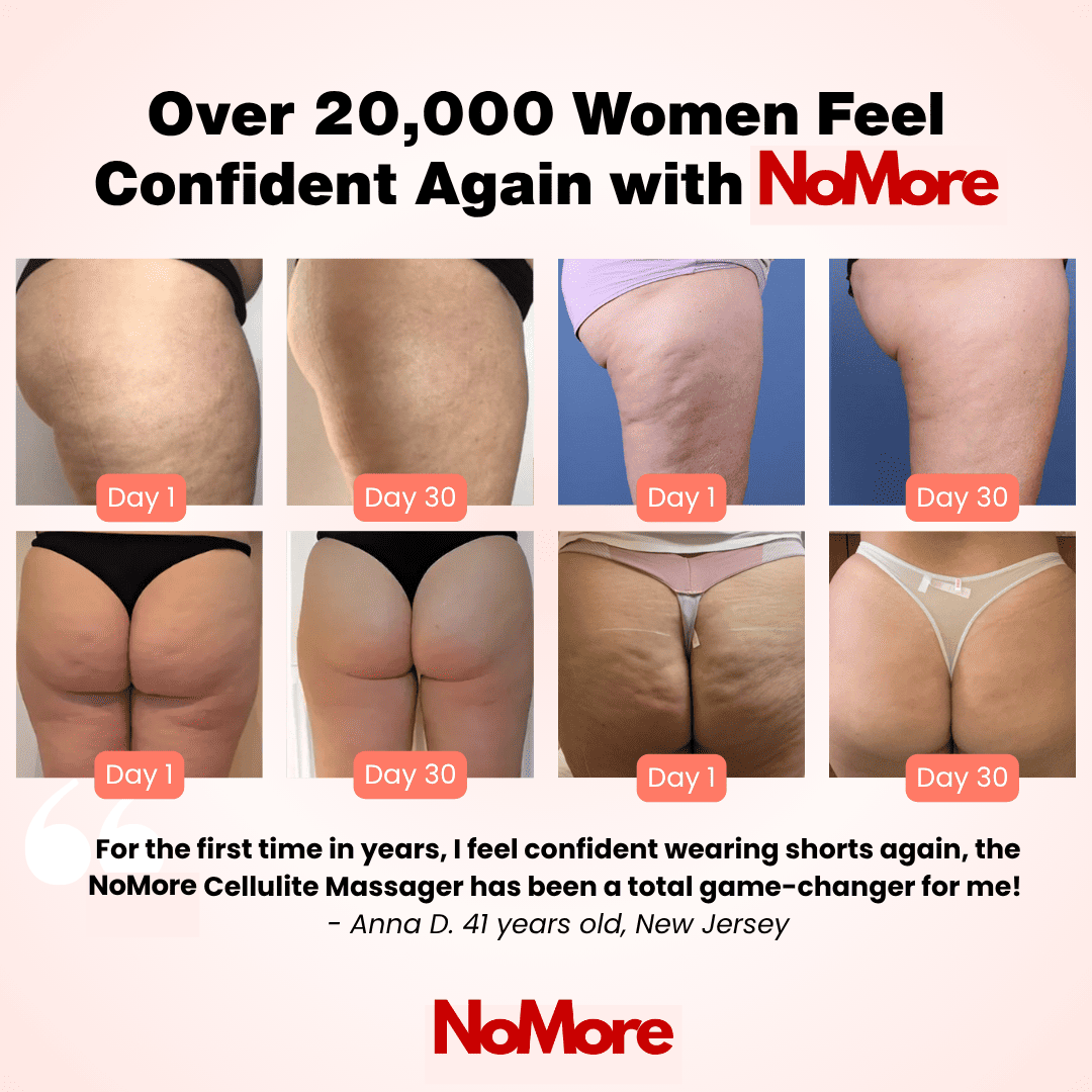 NOMORE® CELLULITE MASSAGER - SPRING SALE
